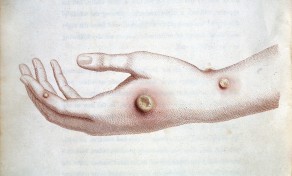M0009446 The hand of Sarah Nelmes infected with the cowpox.